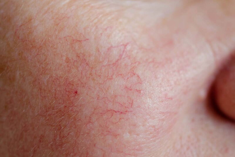 Rosazea - rote Äderchen im Gesicht