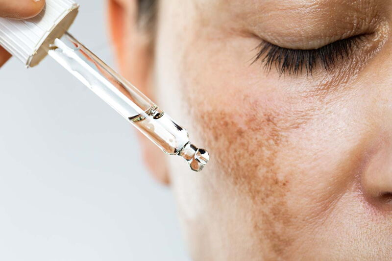 Retinoleeling auf der Wange einer Frau