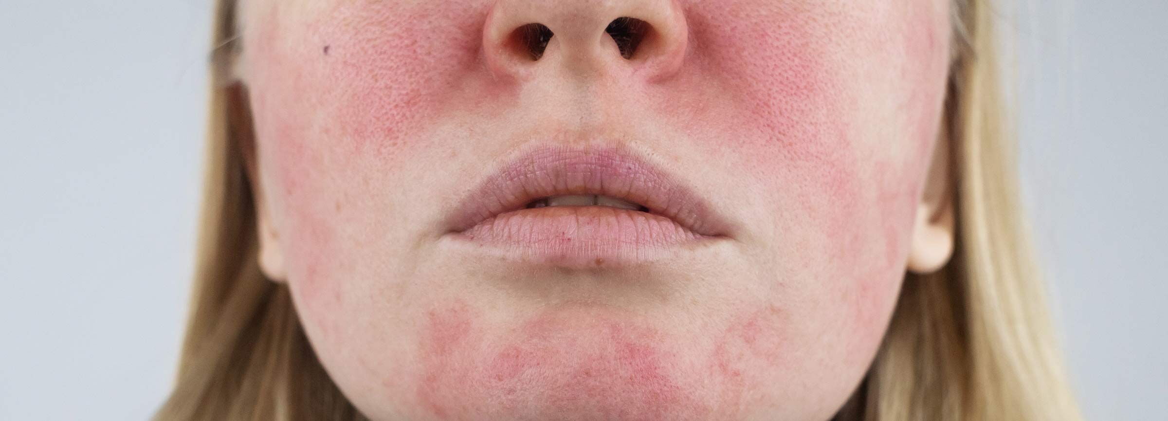 Rosazea im Gesicht einer Frau vor der Behandlung