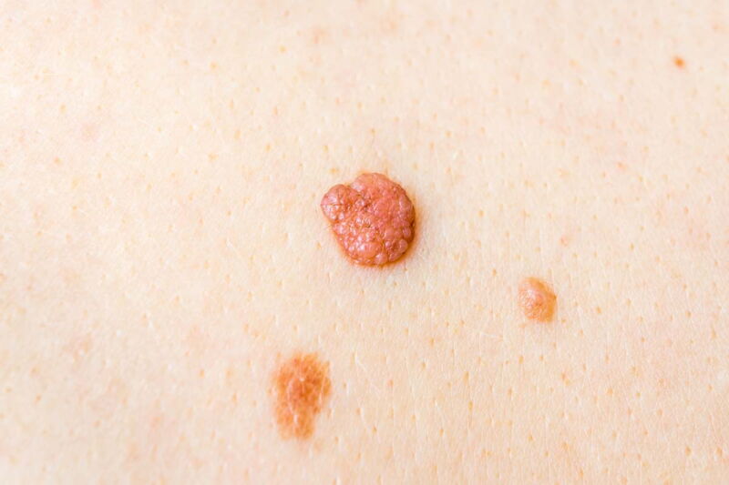 Dermatologie Dr. med. Agata Jost - Abtragung erhabener Hautveränderungen - Warzenbehandlung