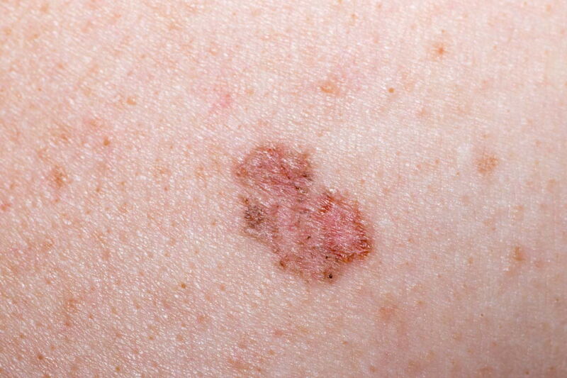 Hautkrebs - Veränderung der Haut in einer Detailansicht