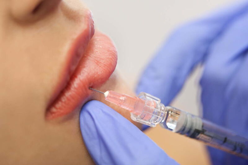 Behandlung mit einem Hyaluron Filler