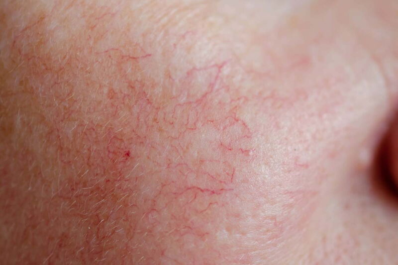 Behandlung und Entfernung von roten Äderchen in der Dermatologie Jost