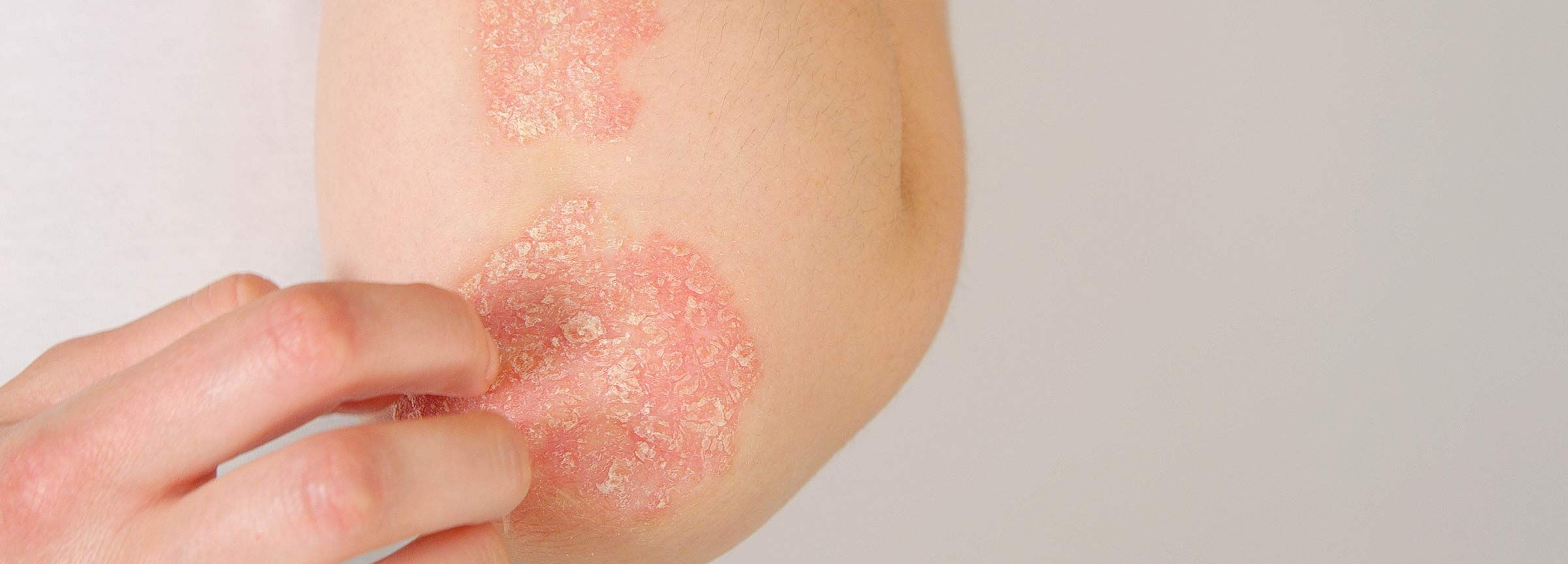 Schuppenflechte vor der dermatologischen Behandlung