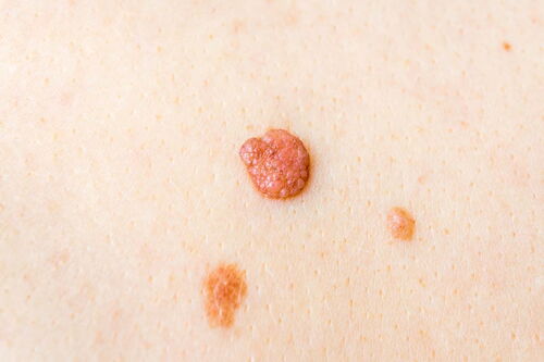 Dermatologie Dr. med. Agata Jost - Abtragung erhabener Hautveränderungen - Warzenbehandlung