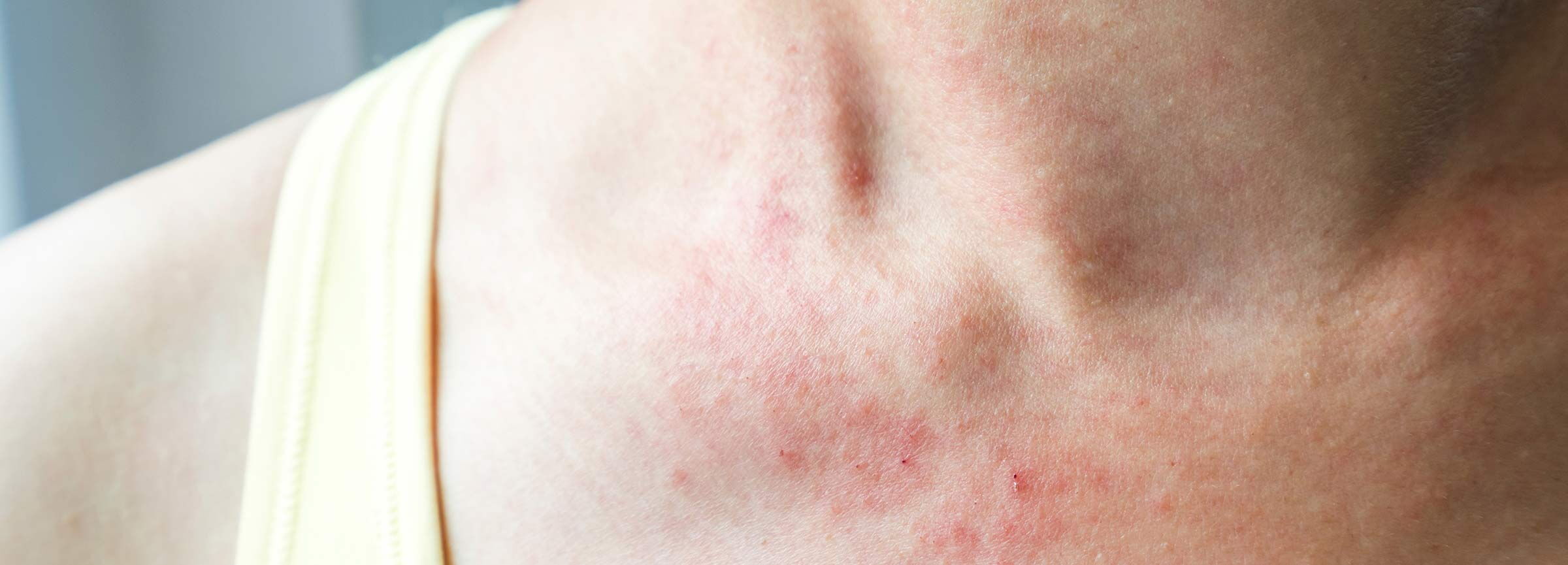 Neurodermitis und Ekzeme im Halsbereich
