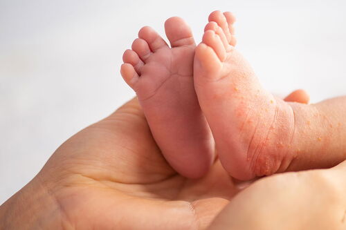 Kinderdermatologie - die Füße eines neugeborenen Babys
