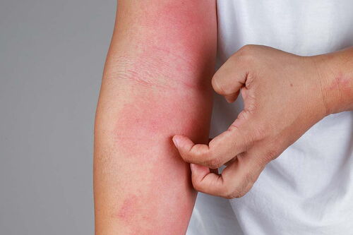 Neurodermitis - rote und juckende Haut am Arm