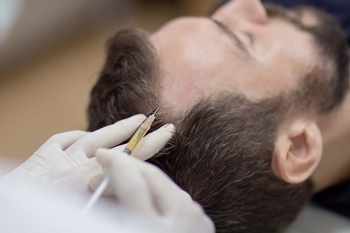 Behandlung der Stirn bei einem Mann mittels PRP