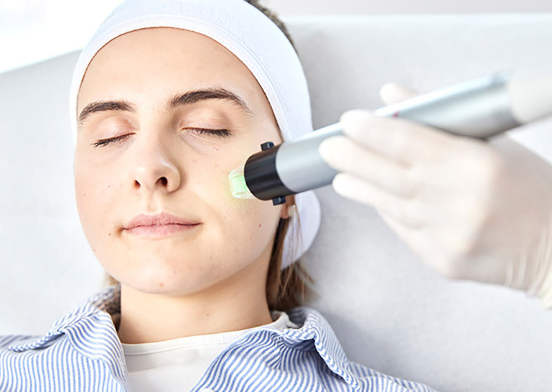 Patientin bekommt eine Radiofrequenz Microneedling Behandlung für ein junges Hautbild in Berlin Zehlendorf