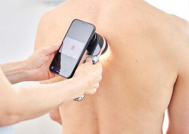 Hautkrebsvorsorgeuntersuchung von Dr. med. Agata Jost